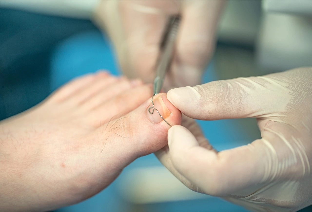 Nagelkorrekturspange Podologie Treichel